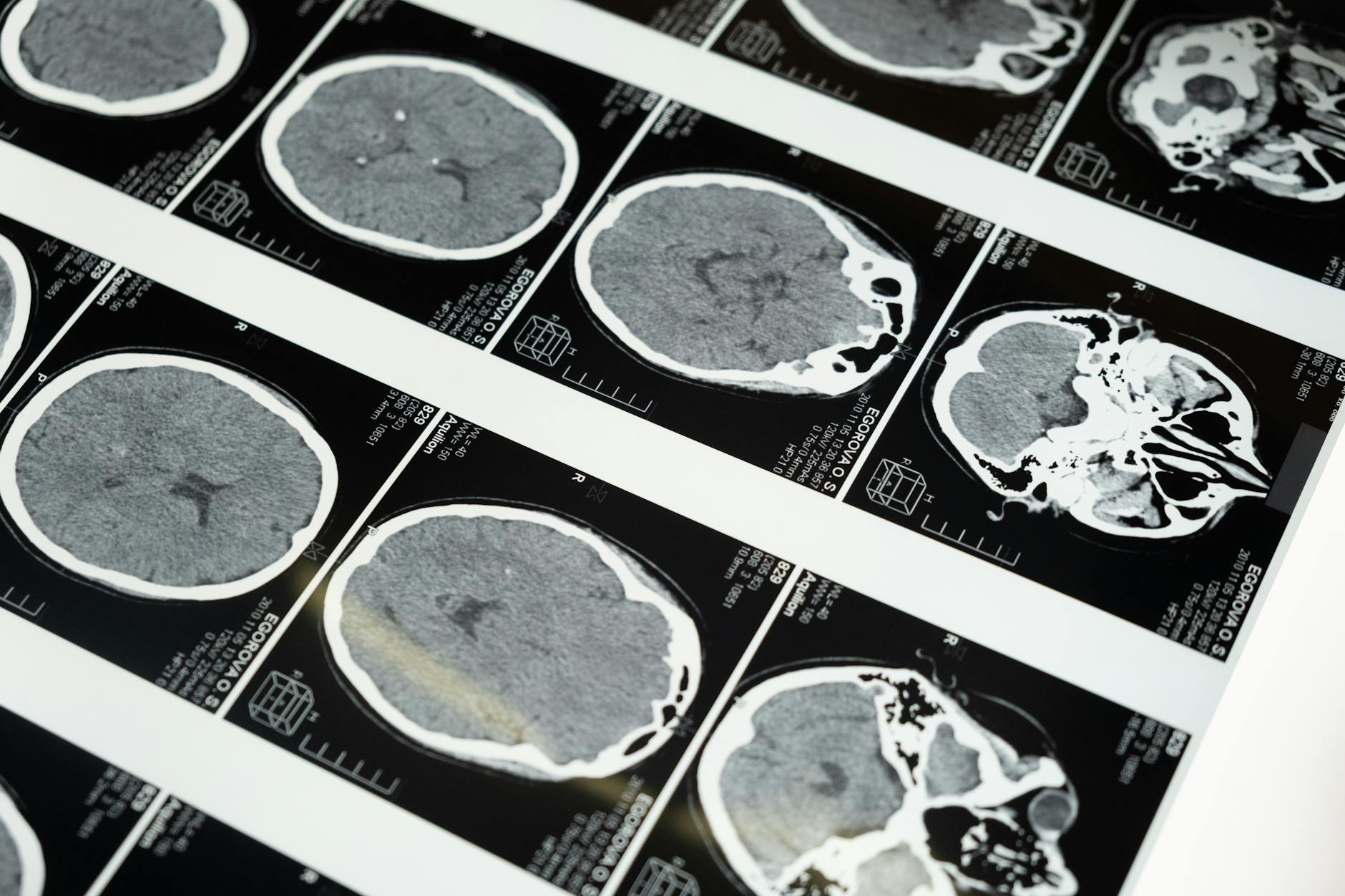 A brain scan with AI-driven analysis, illustrating the use of AI in neurological treatments